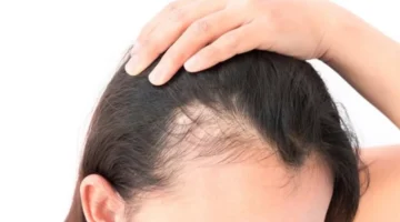 انحسار خط الشعر: الأسباب الطبية والتقنيات الحديثة لعلاجه بفعالية